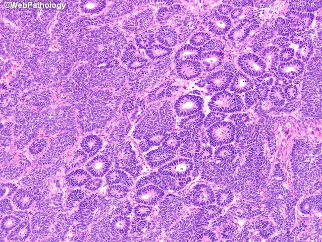 Wilms Tumor : Triphasic