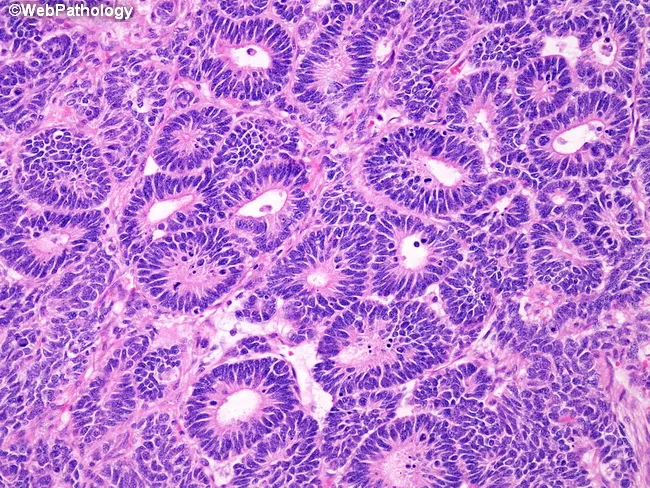 Wilms Tumor : Triphasic