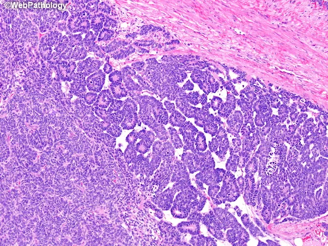 Wilms Tumor : Triphasic