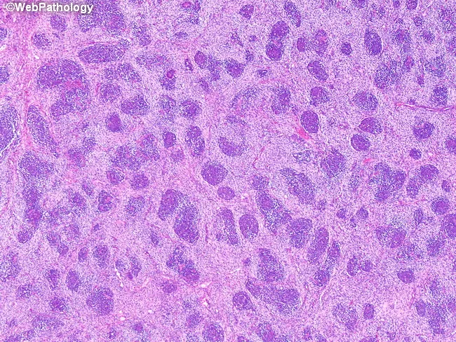 Wilms Tumor : Triphasic