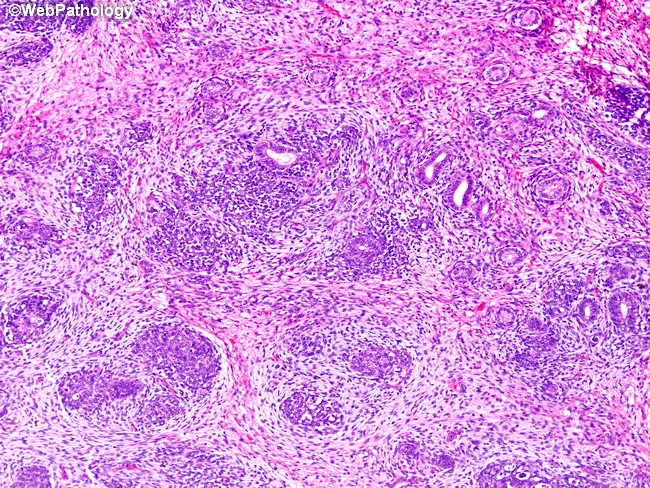 Wilms Tumor : Triphasic