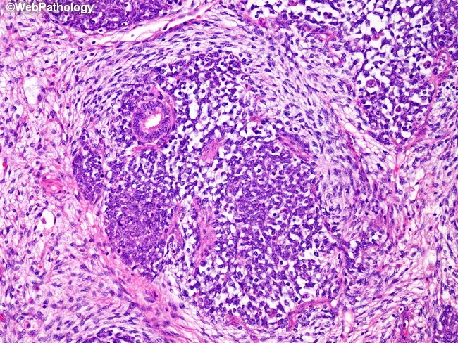 Wilms Tumor : Triphasic