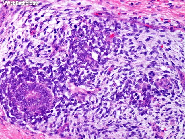 Wilms Tumor : Triphasic