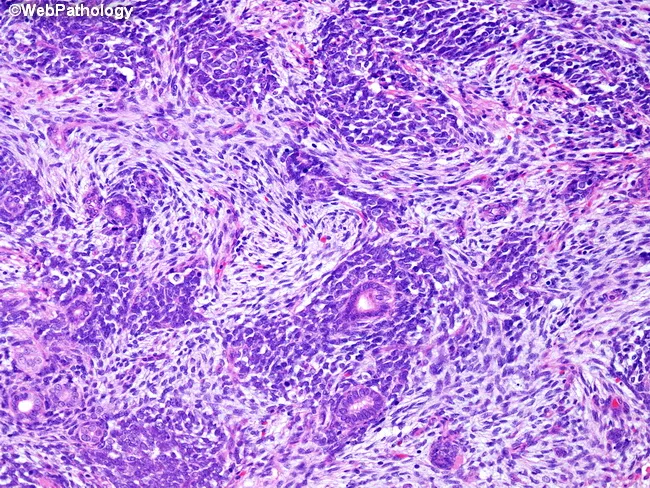 Wilms Tumor : Triphasic