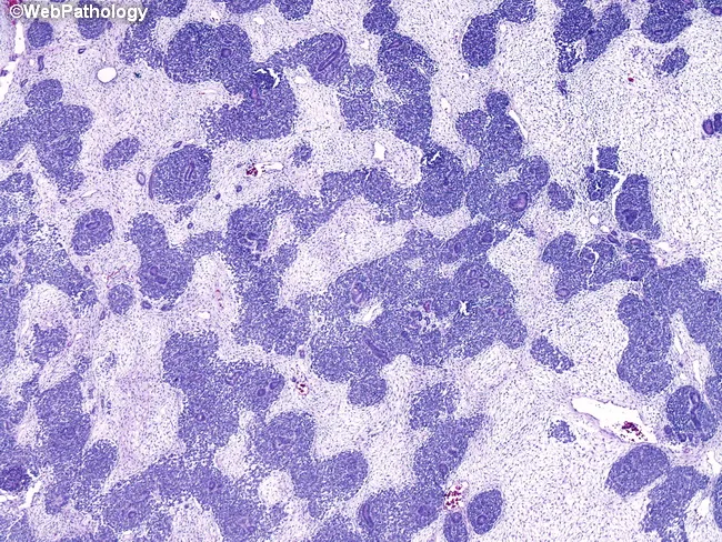 Wilms Tumor : Triphasic