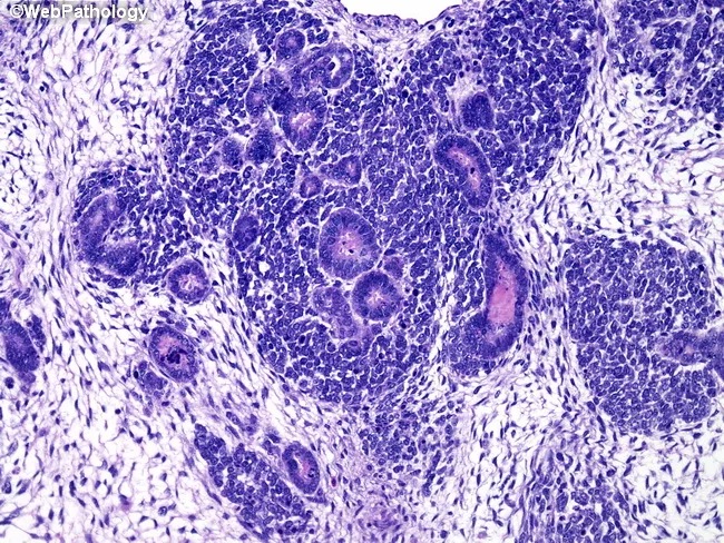 Wilms Tumor : Triphasic