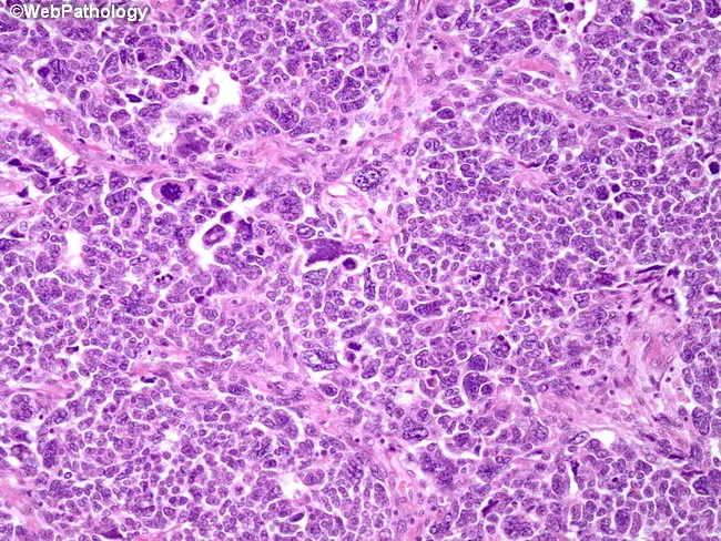Wilms Tumor : Unfavorable Histology