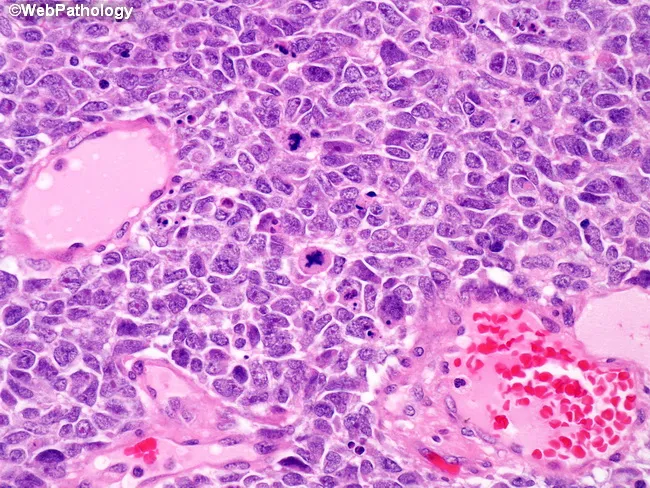 Wilms Tumor : Unfavorable Histology