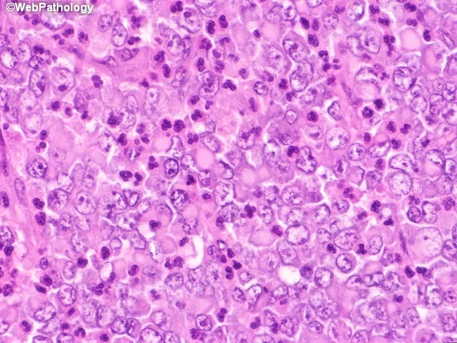 Rhabdoid Tumor
