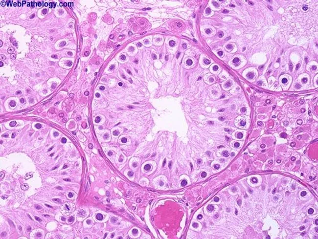 Testes : Maturation Arrest
