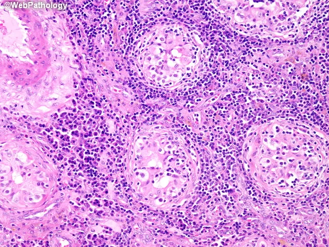 Acute Epididymo-orchitis