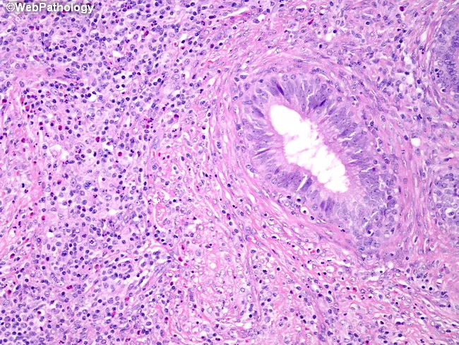 Acute Epididymo-orchitis