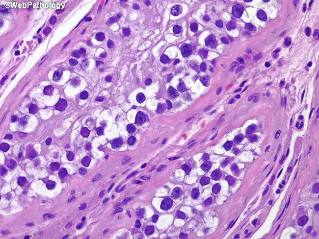 Cryptorchidism Histology Diagram