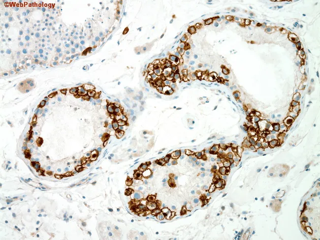 Germ Cell Neoplasia in situ : CD117 (C-kit)