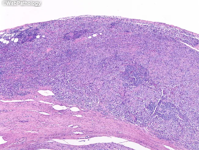 Seminoma : Pathologic Stage T2