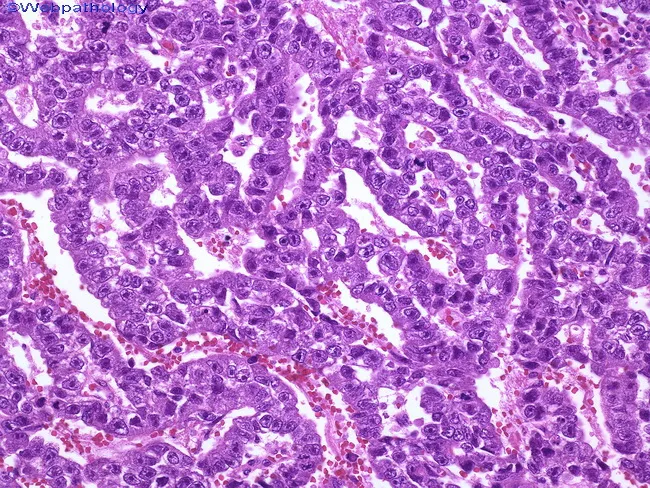 What Is Embryonal Cancer