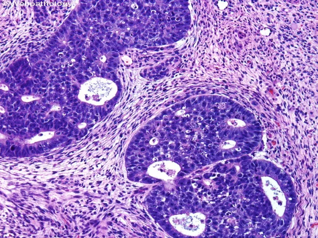 Embryonal Carcinoma - Immature stroma