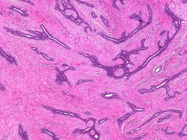 fibroadenoma pathology outlines