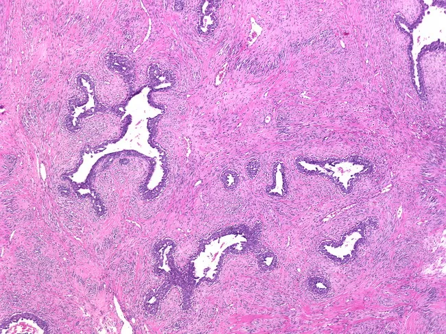 fibroadenoma pathology outlines