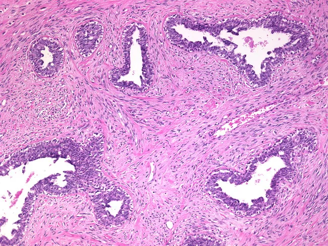 fibroadenoma pathology outlines