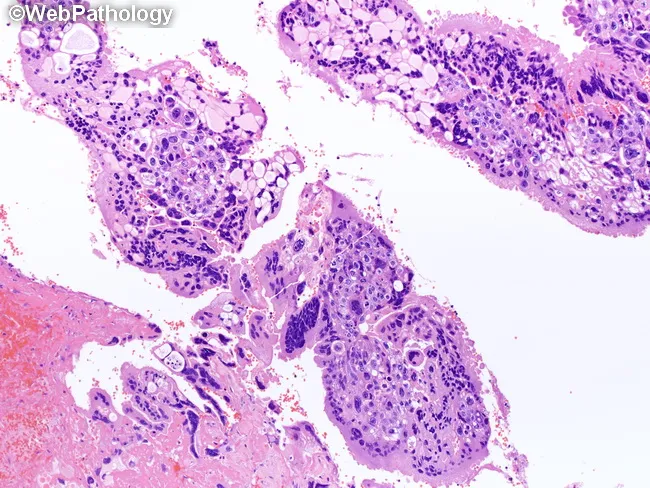 Choriocarcinoma