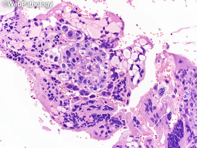 WAT IS CHORIOCARCINOMA visual data 6
