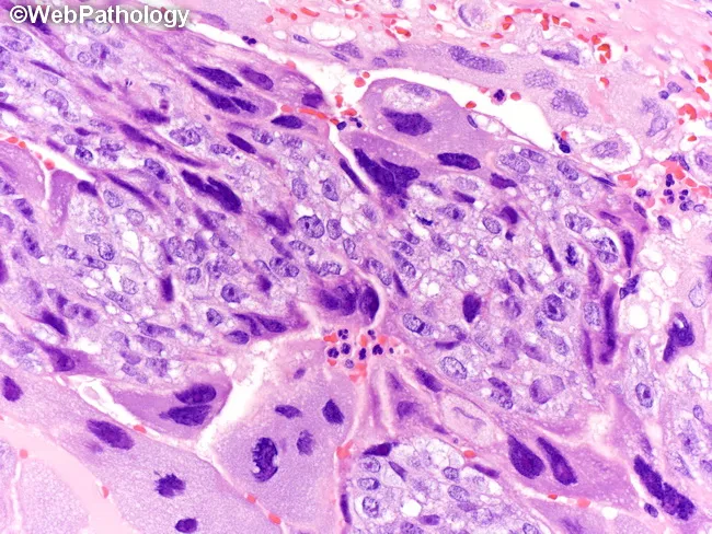 WAT IS CHORIOCARCINOMA visual data 8