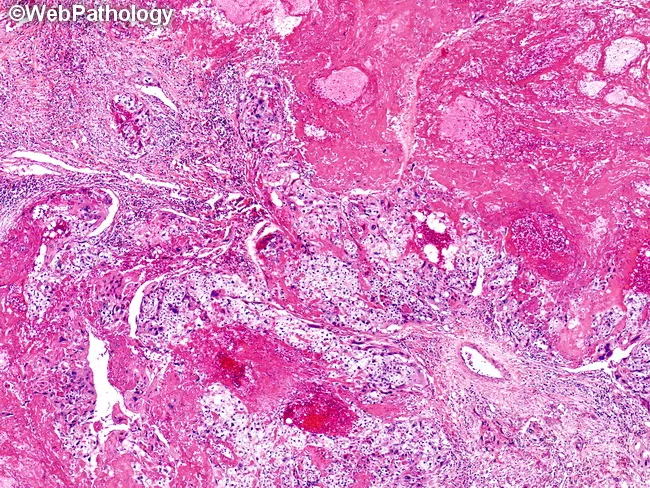 CHORIOCARCINOMA MEDLINEPLUS MEDICAL ENCYCLOPEDIA visual data 8