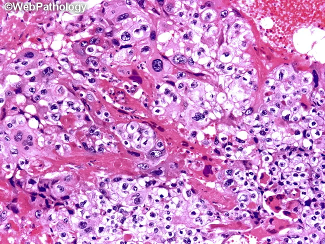 Choriocarcinoma