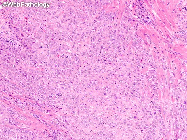 Placental Site Trophoblastic Tumor