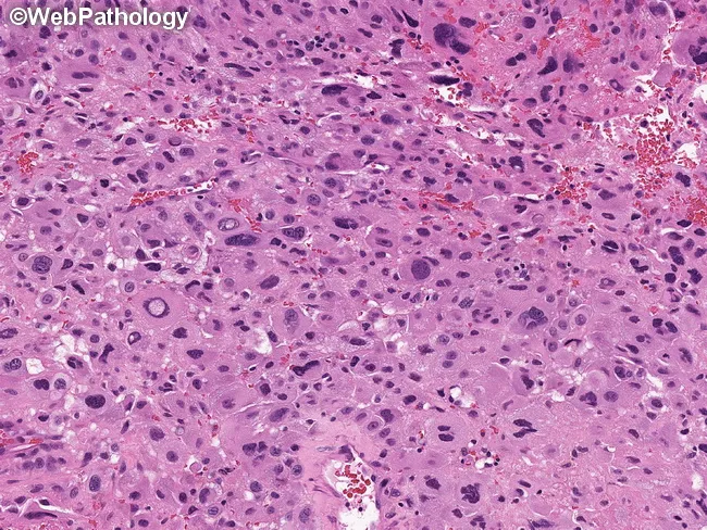 Placental Site Trophoblastic Tumor