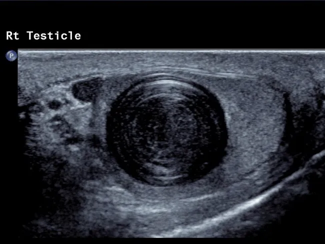 Testicular Epidermoid Cyst : Ultrasound