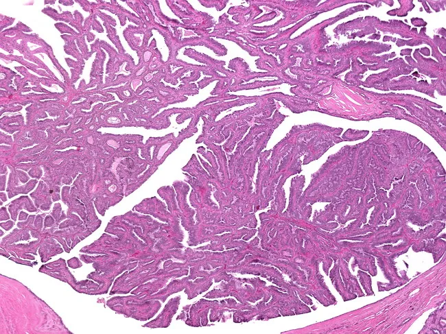 Intraductal Papilloma of Breast