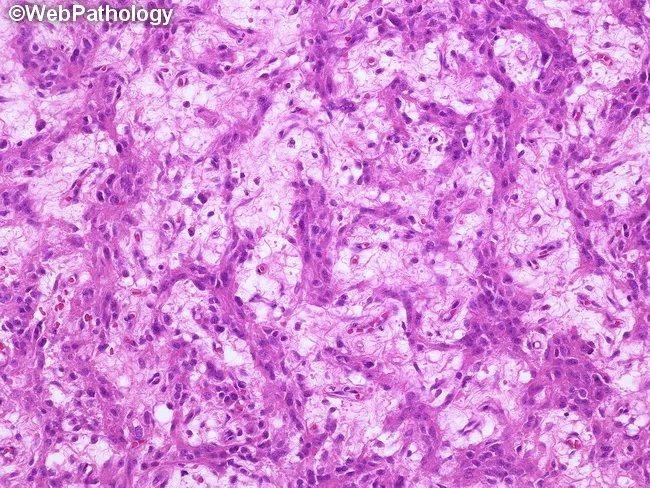Leydig Cell Tumor : Spindle pattern