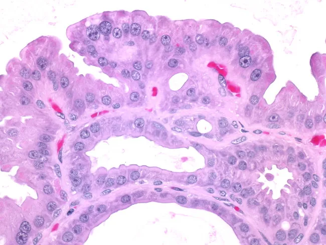 Intraductal Papilloma of Breast : Apocrine change