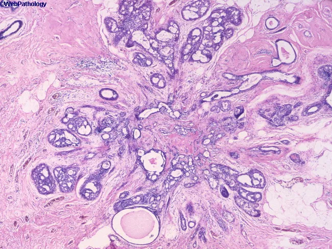 Radial Scar