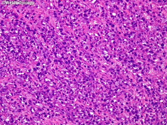 Embryonal Rhabdomyosarcoma