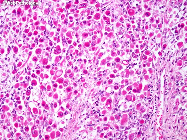Embryonal Rhabdomyosarcoma