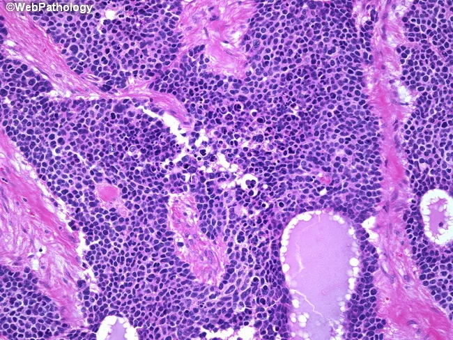 Desmoplastic Small Round Cell Tumor