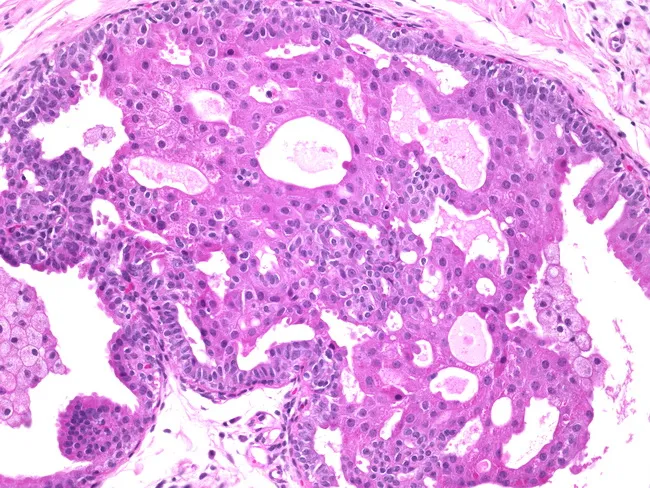 apocrine metaplasia pathology outlines