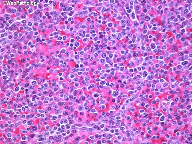 SMZL : Differential Diagnosis