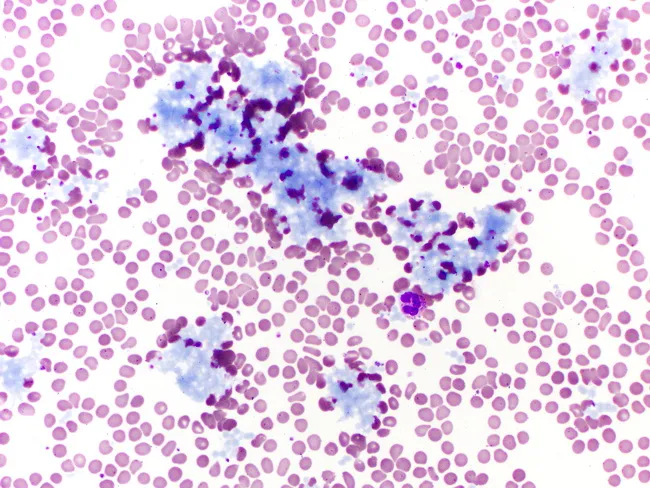 lymphoplasmacytic-lymphoma-peripheral-blood