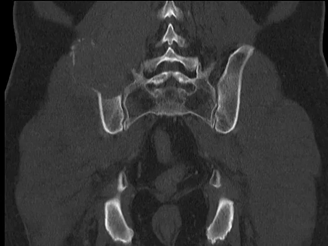 Solitary Plasmacytoma : Bone