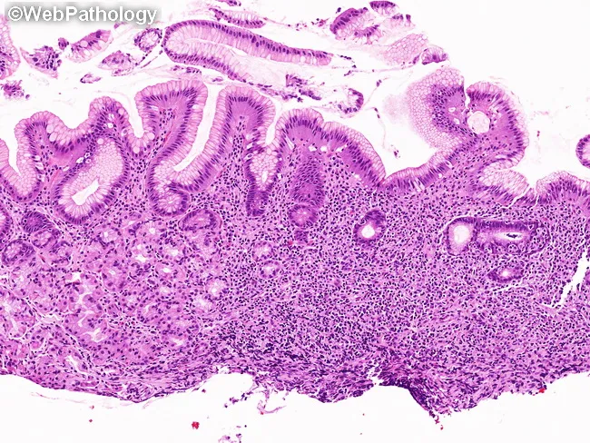 Gastric MALT Lymphoma : Introduction