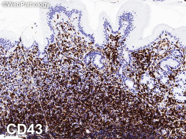 Gastric MALT Lymphoma : CD43