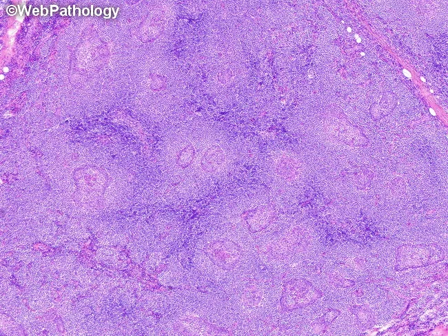 MALT Lymphoma : Parotid