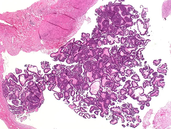 Encapsulated Papillary Carcinoma of Breast