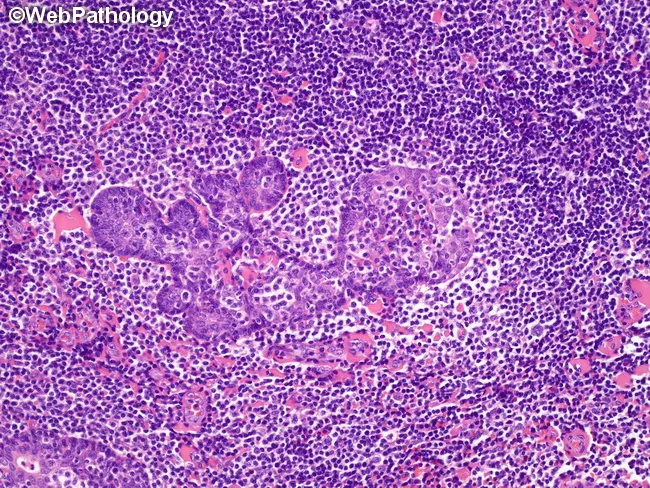 MALT Lymphoma : Parotid