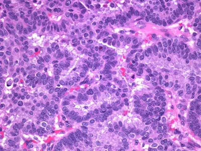 icd 10 code for papillary carcinoma in situ of left breast