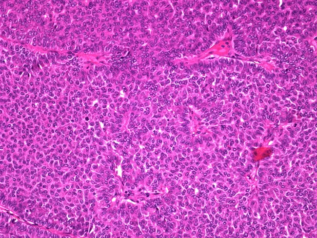 Papillary Carcinoma of Breast : Solid variant